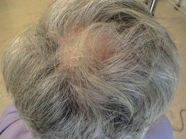 HAIR DISEASES - Follicular Lichen Planus (Lichen Planopilaris)