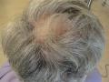 HAIR DISEASES - Follicular Lichen Planus (Lichen Planopilaris)
