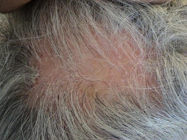 Hair Diseases - Dermatology Sydney