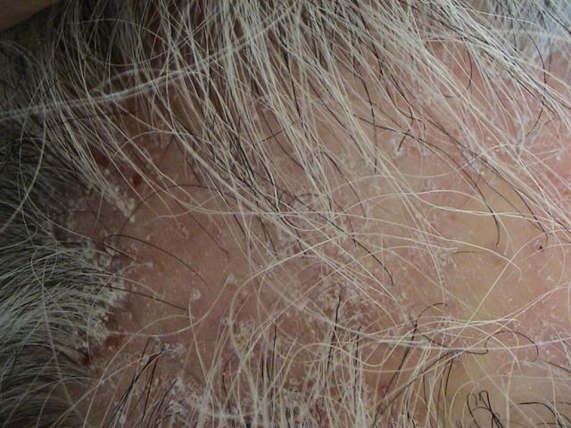 HAIR DISEASES - Follicular Lichen Planus (Lichen Planopilaris) HAIR DISEASES - Follicular Lichen Planus (Lichen Planopilaris)