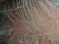 HAIR DISEASES - Follicular Lichen Planus (Lichen Planopilaris)