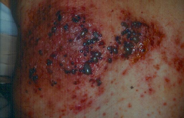 PARASITOSES, BITES - Tick bite PARASITOSES, BITES - Tick bite