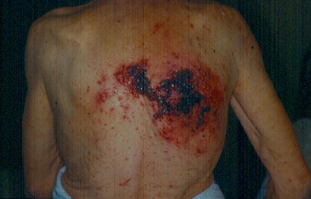 PARASITOSES, BITES - Tick bite PARASITOSES, BITES - Tick bite
