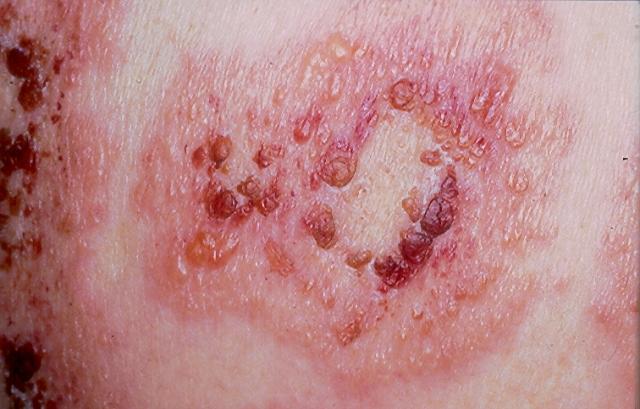 BULLOUS DISEASES - Bullous pemphigoid