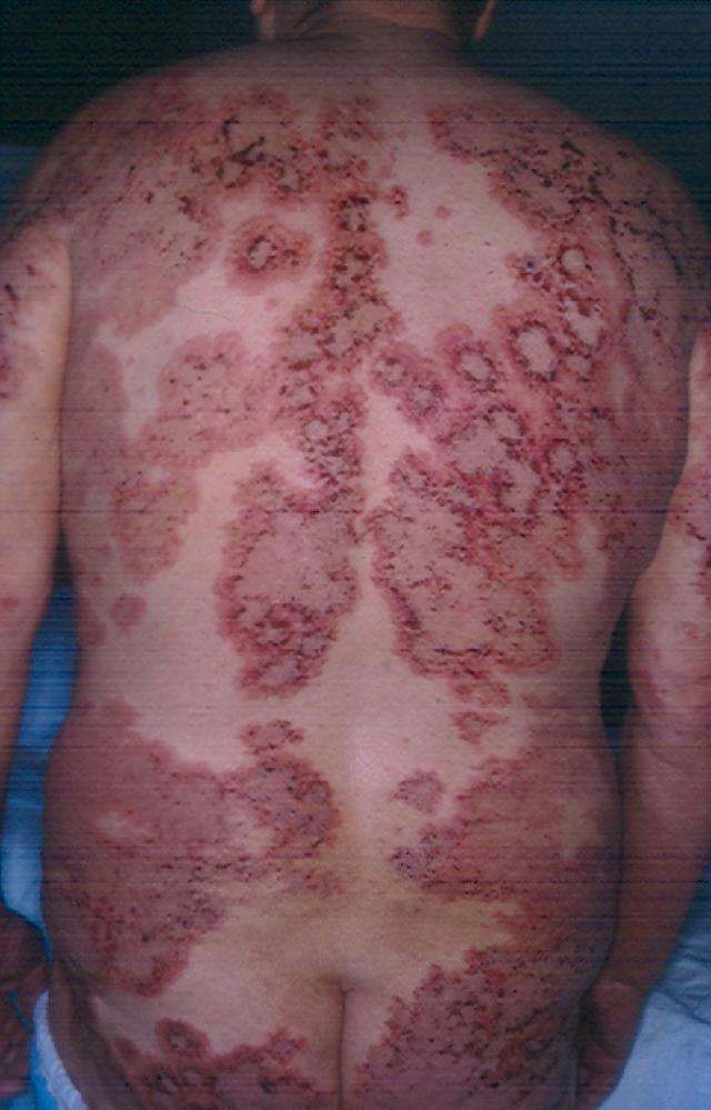 BULLOUS DISEASES - Bullous pemphigoid