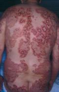 BULLOUS DISEASES - Bullous pemphigoid