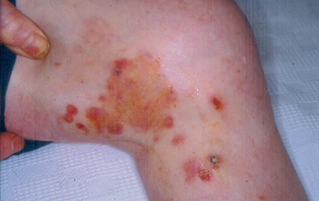 BULLOUS DISEASES - Bullous pemphigoid BULLOUS DISEASES - Bullous pemphigoid