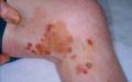 BULLOUS DISEASES - Bullous pemphigoid