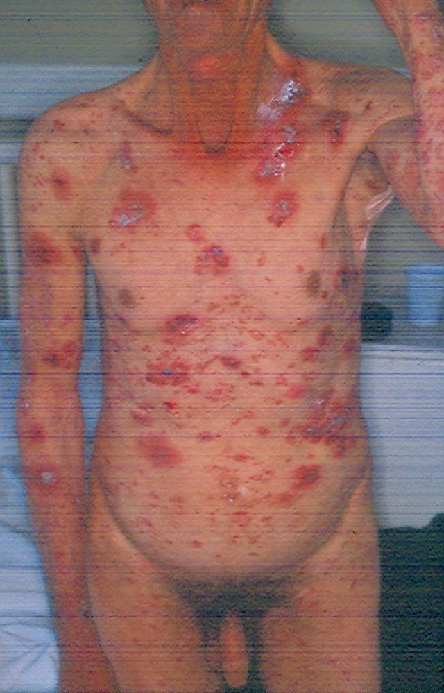 BULLOUS DISEASES - Bullous pemphigoid BULLOUS DISEASES - Bullous pemphigoid