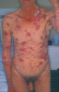 BULLOUS DISEASES - Bullous pemphigoid