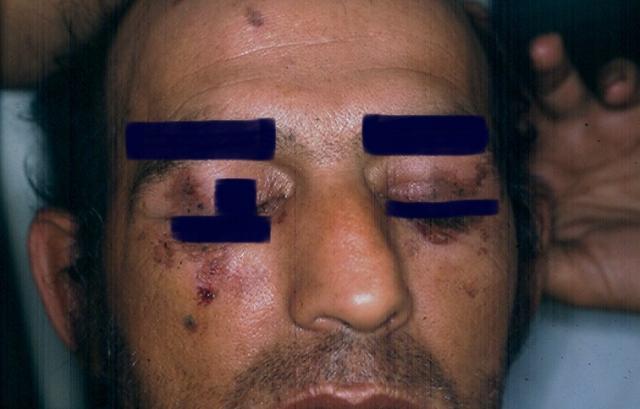 FACTICIAL LESIONS - Factitial lessions from cigarettes FACTICIAL LESIONS - Factitial lessions from cigarettes