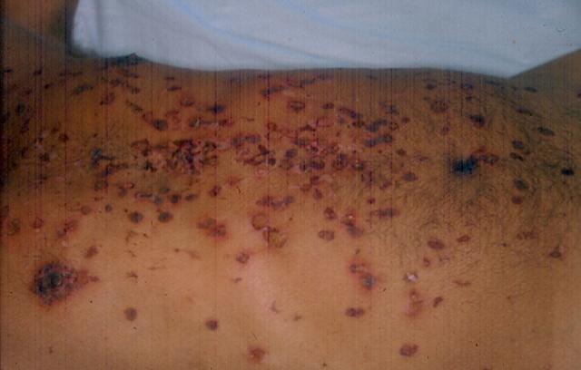 FACTICIAL LESIONS - Factitial lessions from cigarettes FACTICIAL LESIONS - Factitial lessions from cigarettes