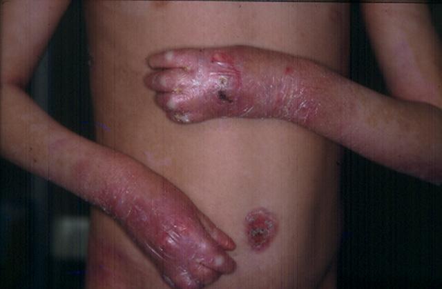 BULLOUS DISEASES - Epidermolysis Bullosa