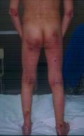 BULLOUS DISEASES - Epidermolysis Bullosa