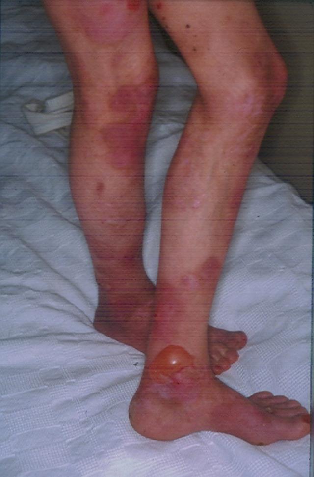 BULLOUS DISEASES - Epidermolysis Bullosa BULLOUS DISEASES - Epidermolysis Bullosa