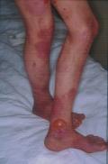 BULLOUS DISEASES - Epidermolysis Bullosa