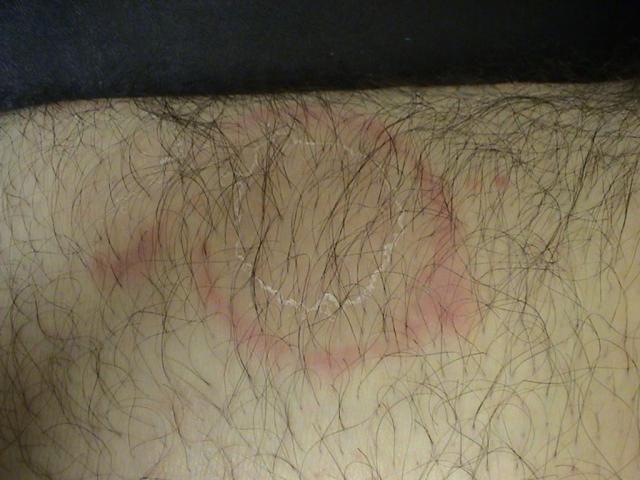 CONNECTIVE TISSUE DISORDERS - SCLE (Subacute Cutaneous Lupus Erythematosus) CONNECTIVE TISSUE DISORDERS - SCLE (Subacute Cutaneous Lupus Erythematosus)
