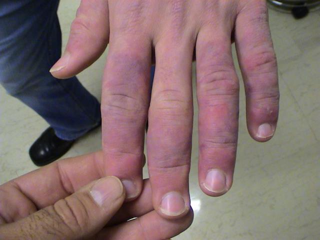 Connective Tissue Disorders Chilblain Lupus Erythematosus Picture