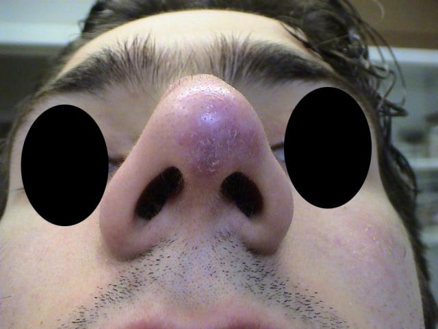 CONNECTIVE TISSUE DISORDERS - Chilblain Lupus Erythematosus CONNECTIVE TISSUE DISORDERS - Chilblain Lupus Erythematosus