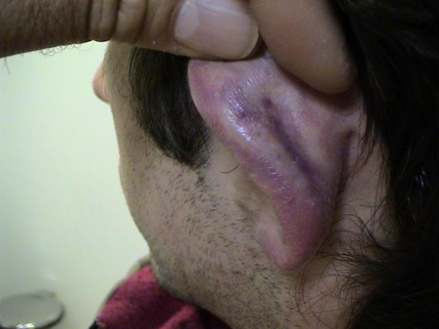 CONNECTIVE TISSUE DISORDERS - Chilblain Lupus Erythematosus CONNECTIVE TISSUE DISORDERS - Chilblain Lupus Erythematosus