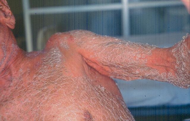GENODERMATOSES - Ichtyosis vulgaris GENODERMATOSES - Ichtyosis vulgaris