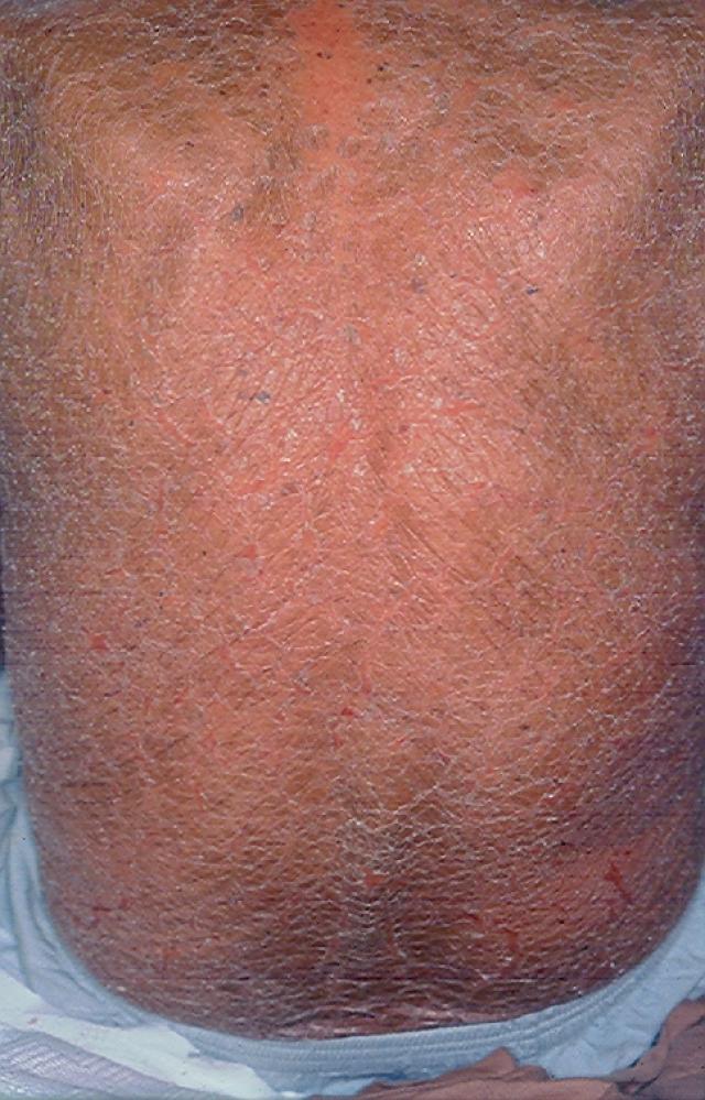 GENODERMATOSES - Ichtyosis vulgaris