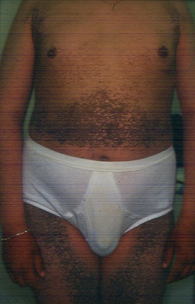 GENODERMATOSES - X-linked Ichthyosis GENODERMATOSES - X-linked Ichthyosis