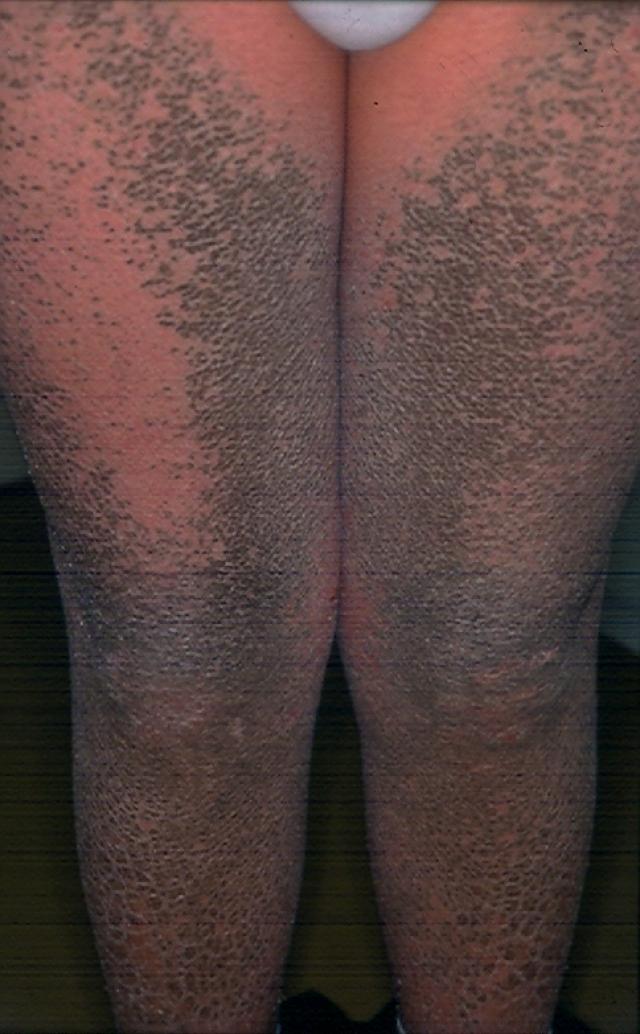 GENODERMATOSES - X-linked Ichthyosis GENODERMATOSES - X-linked Ichthyosis