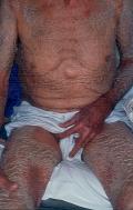 GENODERMATOSES - Ichtyosis vulgaris