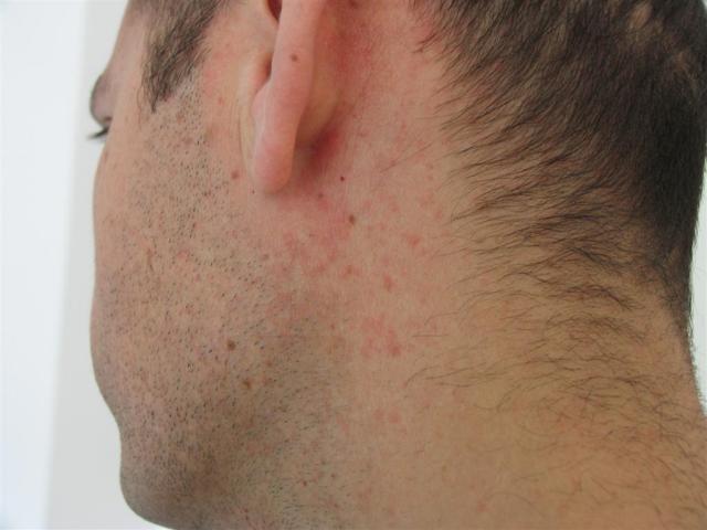 DRUG ERUPTIONS - Maculopapular exanthem due to Clindamycin DRUG ERUPTIONS - Maculopapular exanthem due to Clindamycin