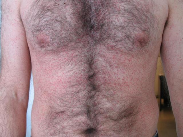 DRUG ERUPTIONS - Maculopapular exanthem due to Clindamycin DRUG ERUPTIONS - Maculopapular exanthem due to Clindamycin