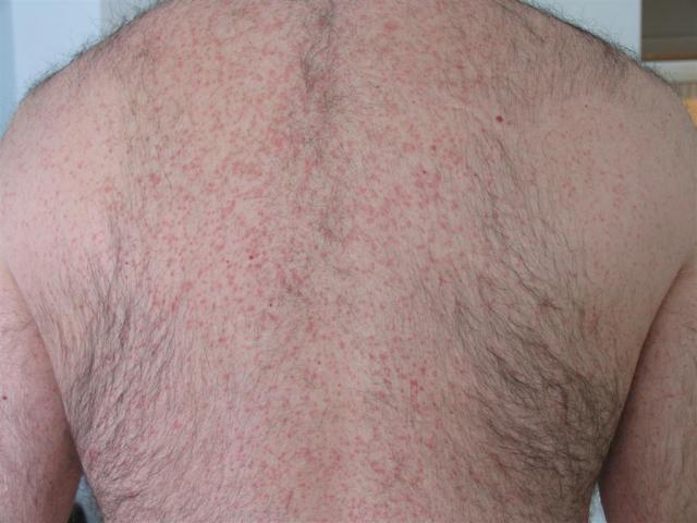 DRUG ERUPTIONS - Maculopapular exanthem due to Clindamycin