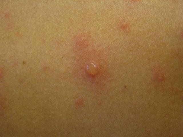VIRAL INFECTIONS - SmallPox VIRAL INFECTIONS - SmallPox