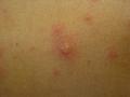 VIRAL INFECTIONS - SmallPox