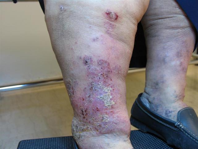 DERMATITIS - EKZEMA - Infected eczema DERMATITIS - EKZEMA - Infected eczema