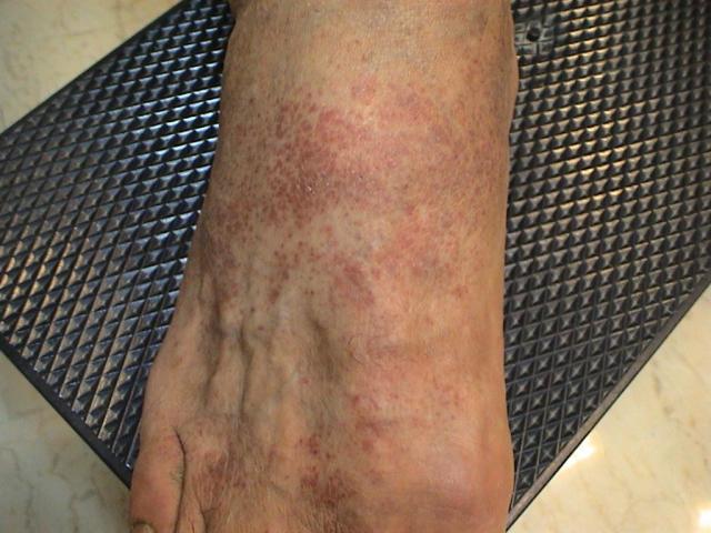 DISEASE OF THE BLOOD AND THE VESSELS – PURPURAS - Eczematoid purpura of Duka-Kapetanaki