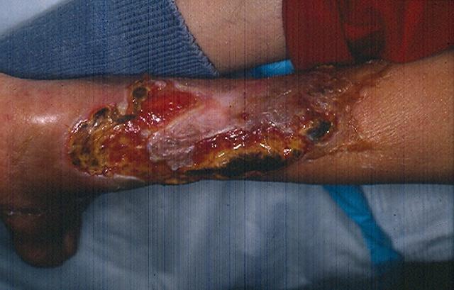 SKIN LESIONS IN SYSTEMIC DISEASES - Diabetes Mellitus