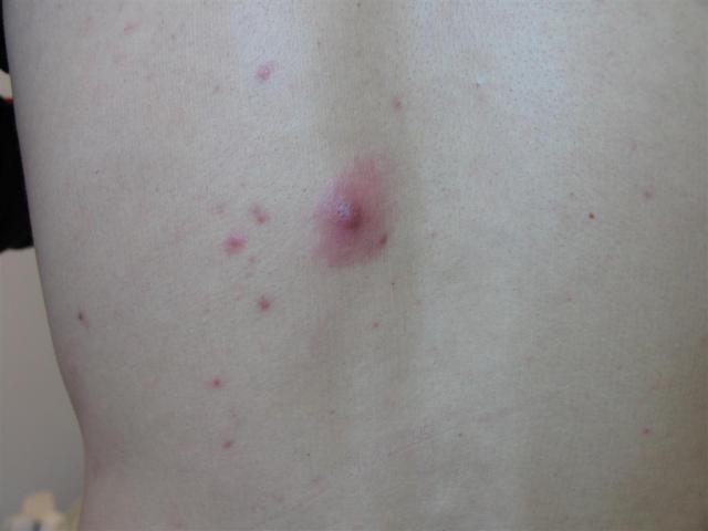 BACTERIAL INFECTIONS - Folliculitis BACTERIAL INFECTIONS - Folliculitis