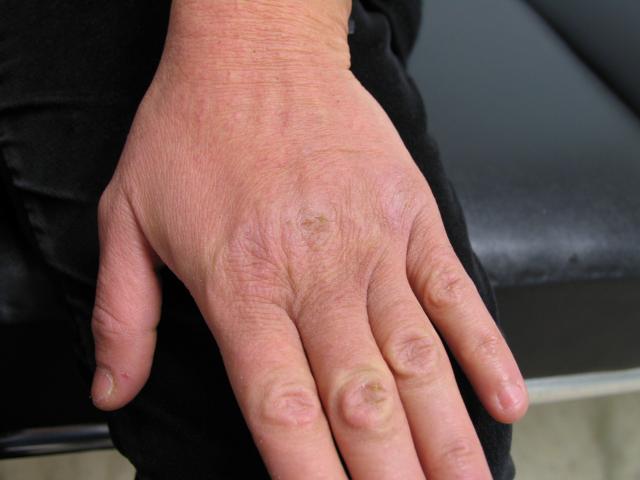 DERMATITIS - EKZEMA - Irritant contact dermatitis DERMATITIS - EKZEMA - Irritant contact dermatitis