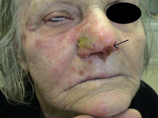 VIRAL INFECTIONS - Herpes Zoster VIRAL INFECTIONS - Herpes Zoster