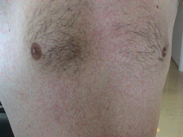 DRUG ERUPTIONS - Maculopapular exanthem due to Clindamycin DRUG ERUPTIONS - Maculopapular exanthem due to Clindamycin