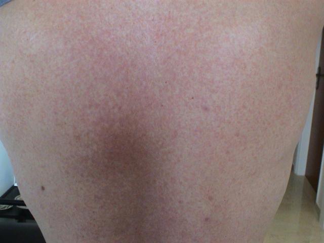 DRUG ERUPTIONS - Maculopapular exanthem due to Clindamycin