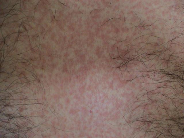 DRUG ERUPTIONS - Maculopapular exanthem due to Clindamycin DRUG ERUPTIONS - Maculopapular exanthem due to Clindamycin