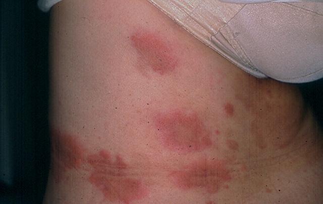 URTICARIA - Urticarial Vasculitis