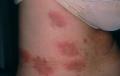 URTICARIA - Urticarial Vasculitis