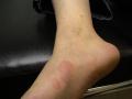 URTICARIA - Urticaria