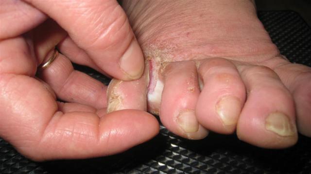 SUPERFICIAL FUNGAL INFECTIONS - Tinea pedis (Athlet's foot)