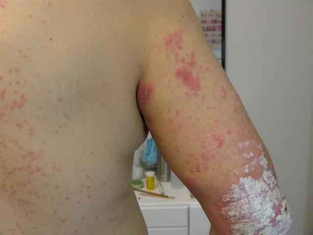 VIRAL INFECTIONS - Herpes Zoster VIRAL INFECTIONS - Herpes Zoster