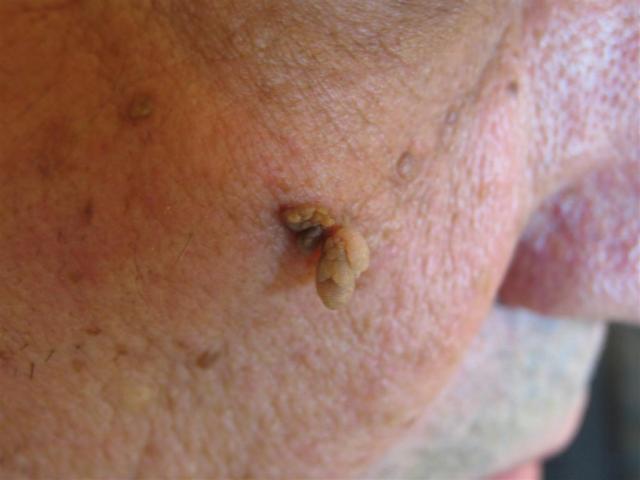 BENIGN SKIN LESIONS, NEVI, CYSTS - Acrochordon (Skin Tag) BENIGN SKIN LESIONS, NEVI, CYSTS - Acrochordon (Skin Tag)