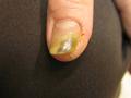 NAIL DISEASES - Onychomycosis